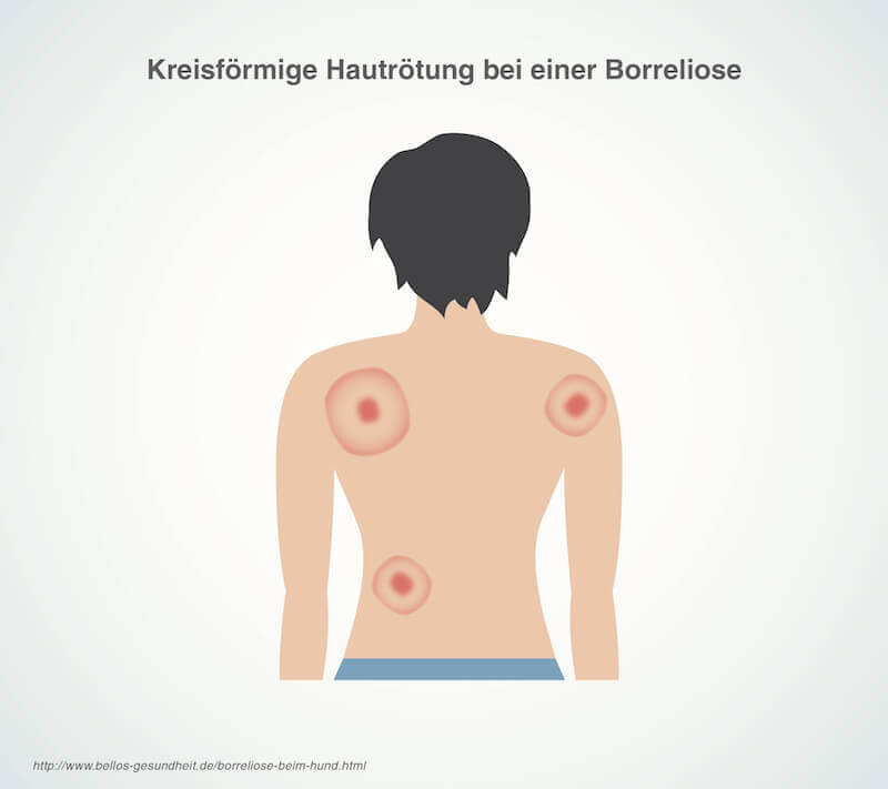 borreliose-symptome